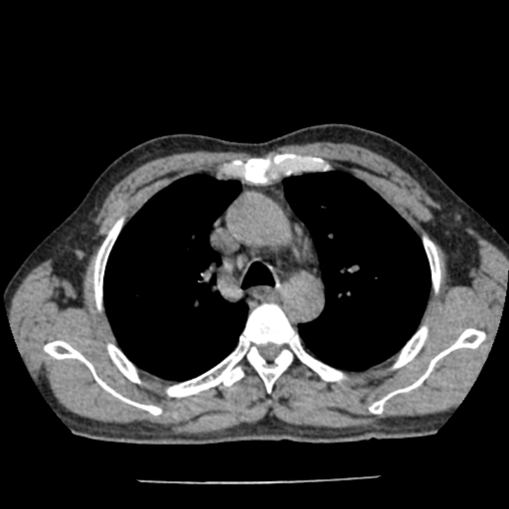 Airway foreign body in adult (Radiopaedia 85907-101779 Axial liver window 46).jpg