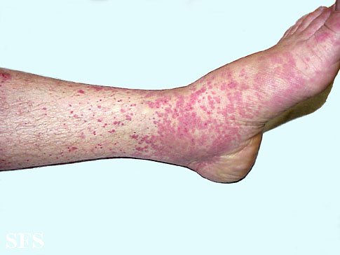 Allergic Vasculitis (Dermatology Atlas 4).jpg
