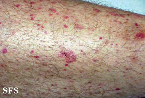 Allergic Vasculitis (Dermatology Atlas 6).jpg