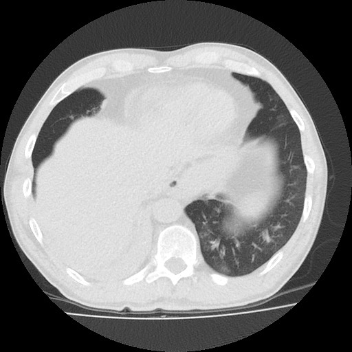 File:Allergic bronchopulmonary aspergillosis (ABPA) (Radiopaedia 60594-68313 Axial lung window 47).jpg