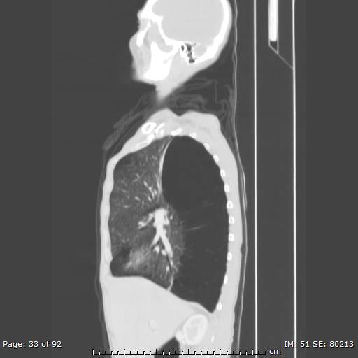 File:Alpha-1-antitrypsin deficiency (Radiopaedia 50561-55987 Sagittal lung window 16).jpg