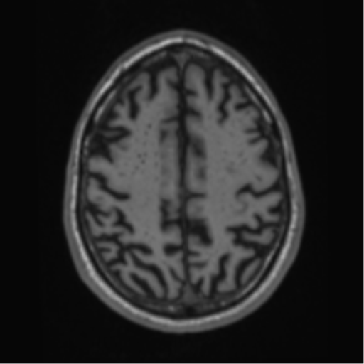Alzheimer's disease- with Gerstmann syndrome and dressing apraxia (Radiopaedia 54882-61150 Axial T1 57).png