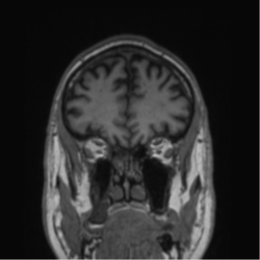 Alzheimer's disease- with Gerstmann syndrome and dressing apraxia (Radiopaedia 54882-61150 Coronal T1 71).png