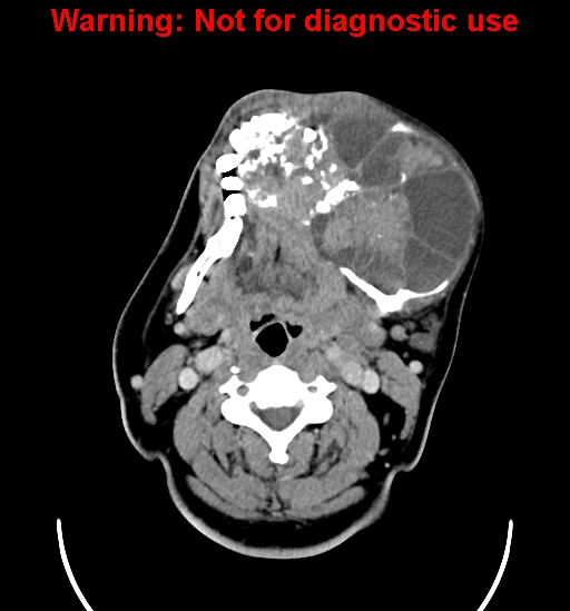 File:Ameloblastoma (Radiopaedia 33126-34164 B 12).jpg