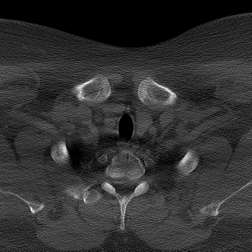 Ameloblastoma (Radiopaedia 38520-40623 Axial bone window 73).png