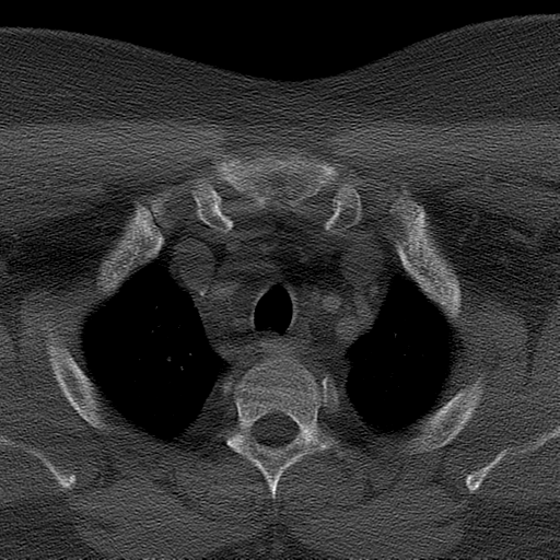 Ameloblastoma (Radiopaedia 38520-40623 Axial bone window 78).png