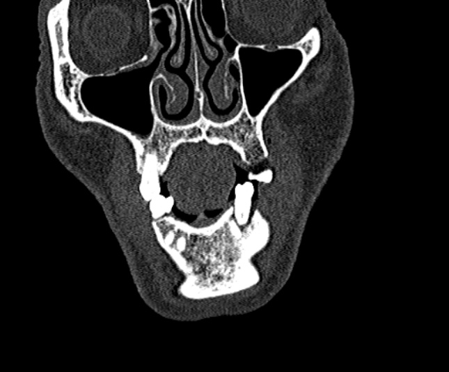Ameloblastoma (Radiopaedia 51921-57766 Coronal bone window 42).jpg