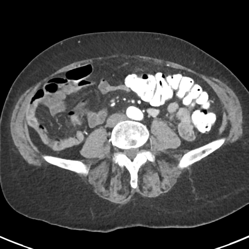 Ampullary adenocarcinoma (Radiopaedia 34013-35237 B 61).png