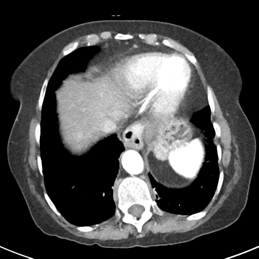 Ampullary adenocarcinoma (Radiopaedia 34013-35237 B 8).png