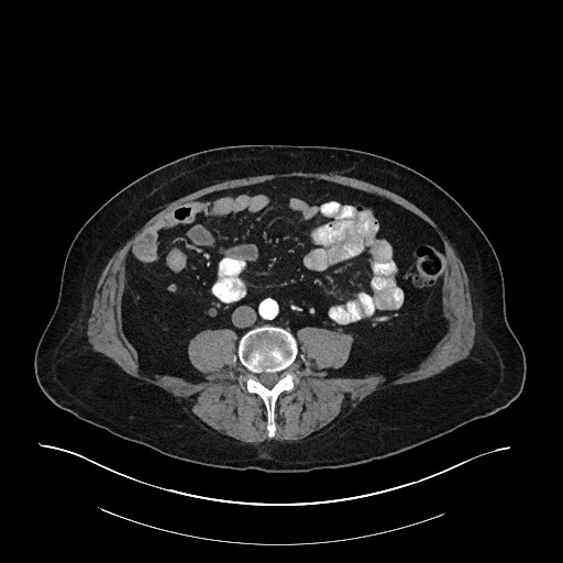 Ampullary adenocarcinoma (Radiopaedia 59373-66734 A 102).jpg