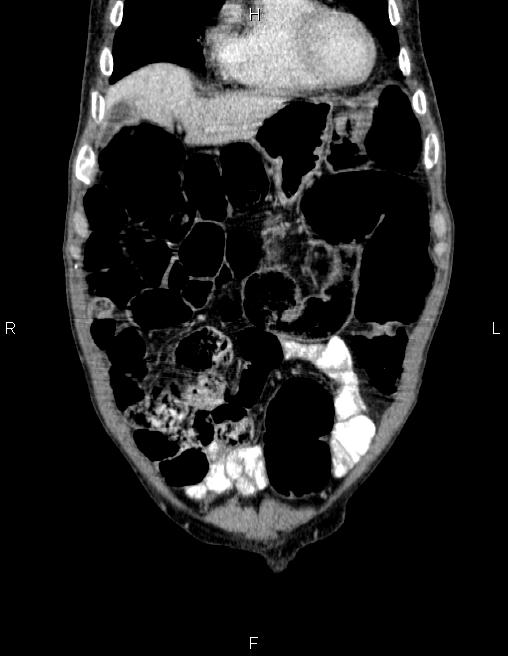 Ampullary adenocarcinoma (Radiopaedia 86093-102032 C 13).jpg