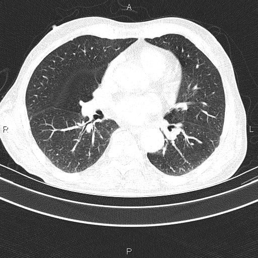 Ampullary adenocarcinoma (Radiopaedia 86093-102033 Axial lung window 35).jpg