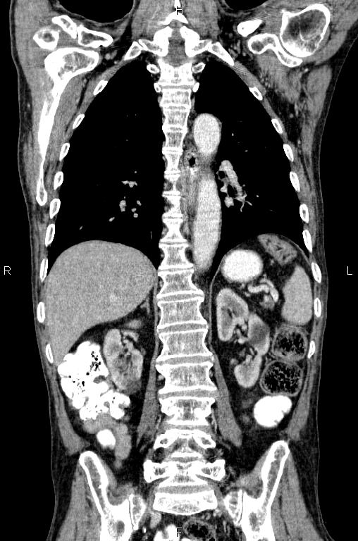 Ampullary adenocarcinoma (Radiopaedia 86093-102033 D 40).jpg