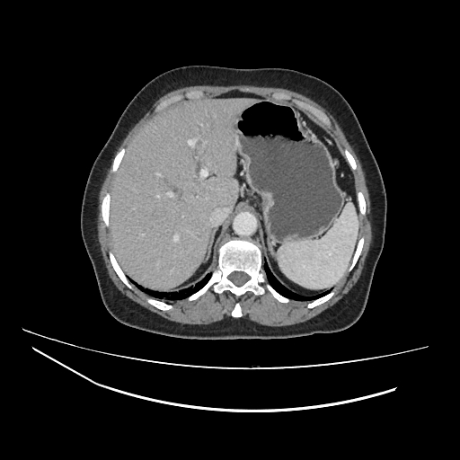 Ampullary tumor (Radiopaedia 60333-67998 A 15).jpg