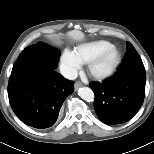 File:Amyand hernia (Radiopaedia 39300-41547 A 2).png