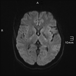 File:Amyotrophic lateral sclerosis (Radiopaedia 70821-81017 Axial DWI 7).jpg