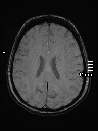 Amyotrophic lateral sclerosis (Radiopaedia 70821-81017 Axial SWI 34).jpg