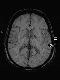 File:Amyotrophic lateral sclerosis (Radiopaedia 70821-81017 Axial SWI minIP 25).jpg