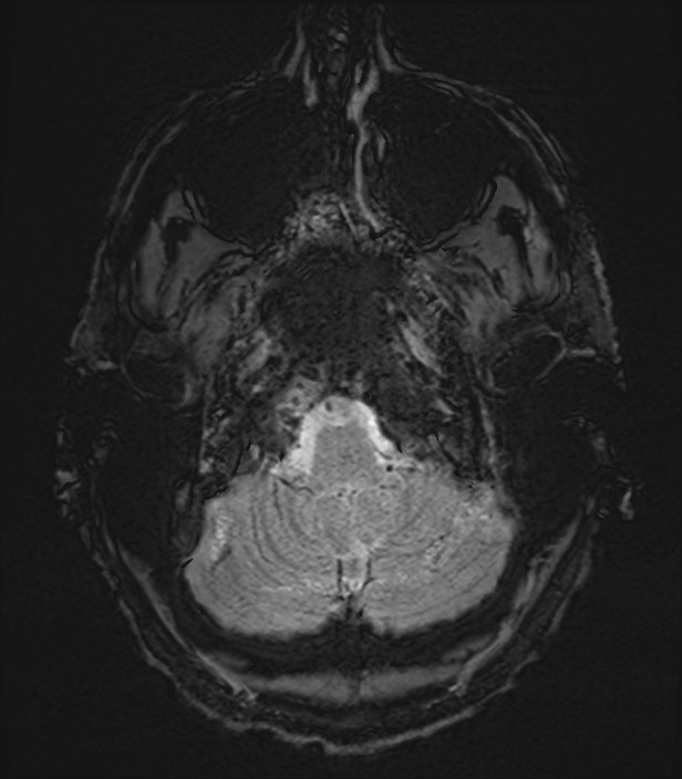 Amyotrophic lateral sclerosis (Radiopaedia 87352-103658 Axial SWI 1).jpg