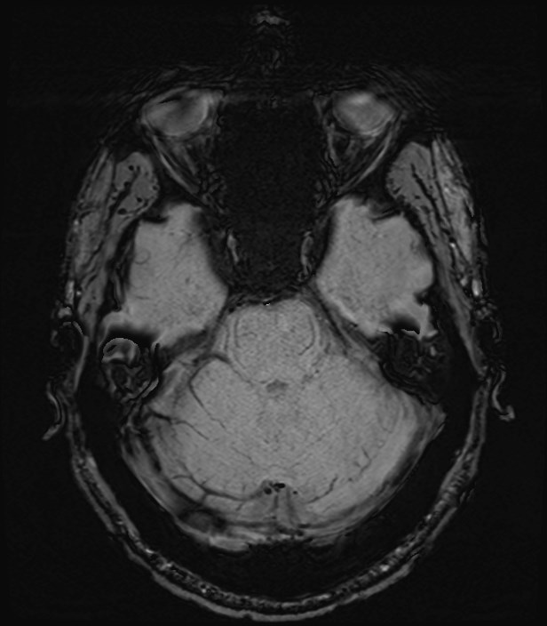Amyotrophic lateral sclerosis (Radiopaedia 87352-103658 Axial SWI 13).jpg
