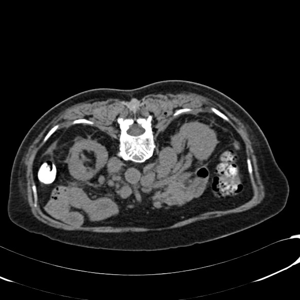 File:Anaplastic lymphoma - with CT biopsy (Radiopaedia 21643-21603 Axial non-contrast 1).jpg