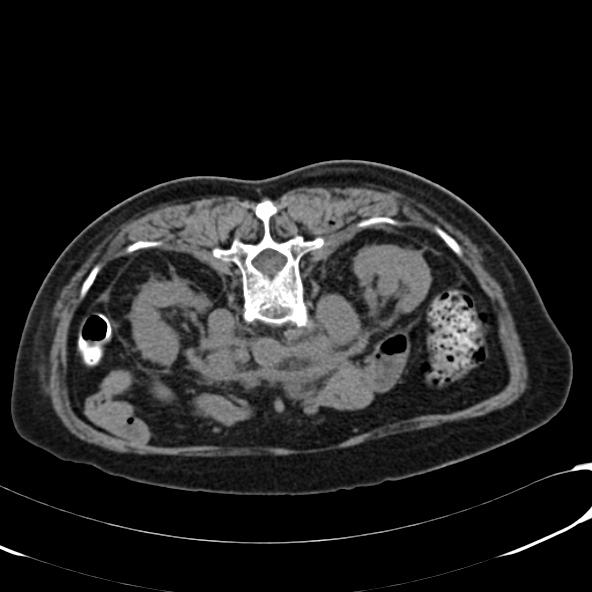 File:Anaplastic lymphoma - with CT biopsy (Radiopaedia 21643-21603 Axial non-contrast 4).jpg
