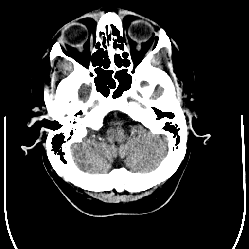 File:Anaplastic meningioma with recurrence (Radiopaedia 34452-35781 Axial non-contrast 6).png