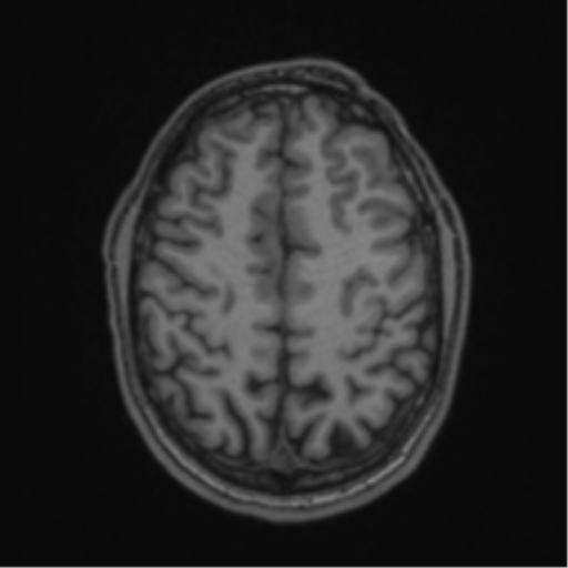 Anaplastic oligodendroglioma with skull fracture (Radiopaedia 74831-85845 Axial T1 50).png