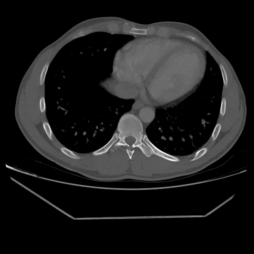 File:Aneurysmal bone cyst - rib (Radiopaedia 82167-96220 Axial bone window 183).jpg