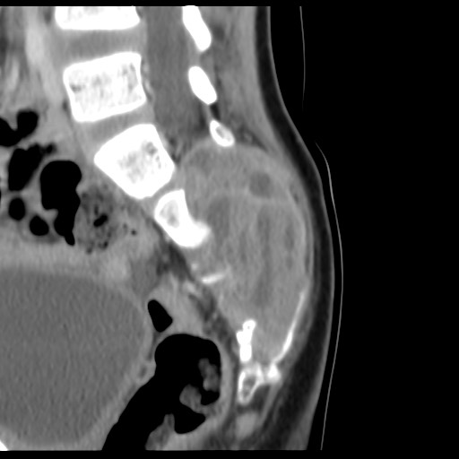 File:Aneurysmal bone cyst - sacrum (Radiopaedia 65190-74195 A 18).jpg