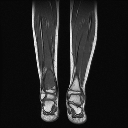 File:Aneurysmal bone cyst - tibia (Radiopaedia 22343-22367 Coronal T1 11).jpg