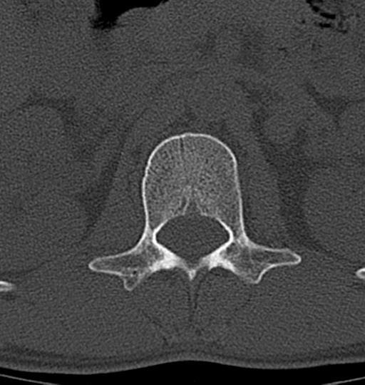 File:Aneurysmal bone cyst T11 (Radiopaedia 29294-29721 Axial bone window 64).jpg