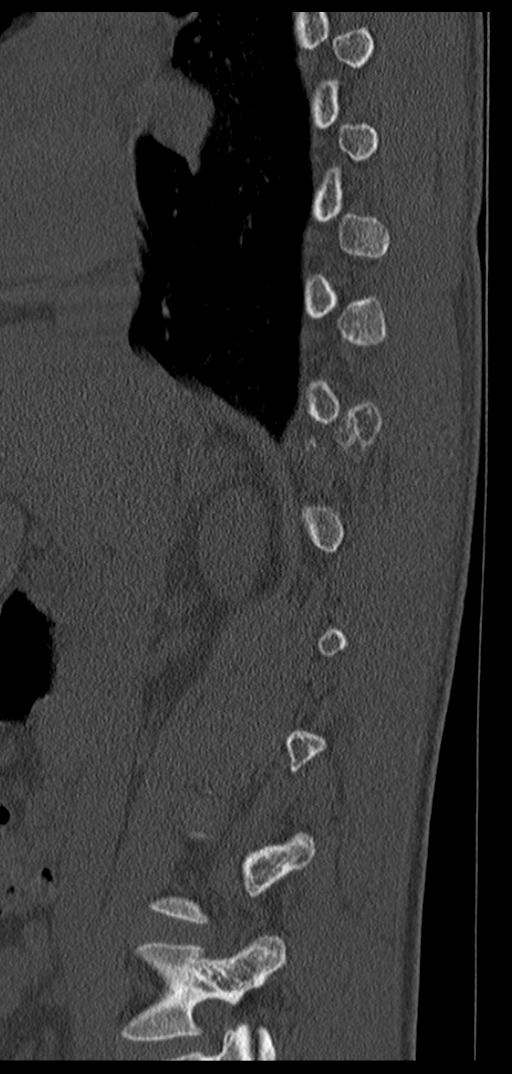 Aneurysmal bone cyst T11 (Radiopaedia 29294-29721 Sagittal bone window 56).jpg