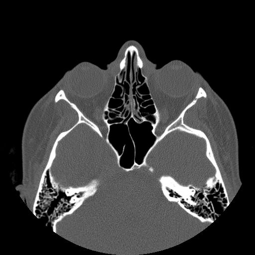 Aneurysmal bone cyst of the mandible (Radiopaedia 43280-46823 Axial bone window 164).jpg