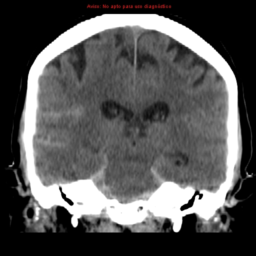File:Aneurysmal subarachnoid hemorrhage (Radiopaedia 24740-24997 Coronal non-contrast 27).jpg