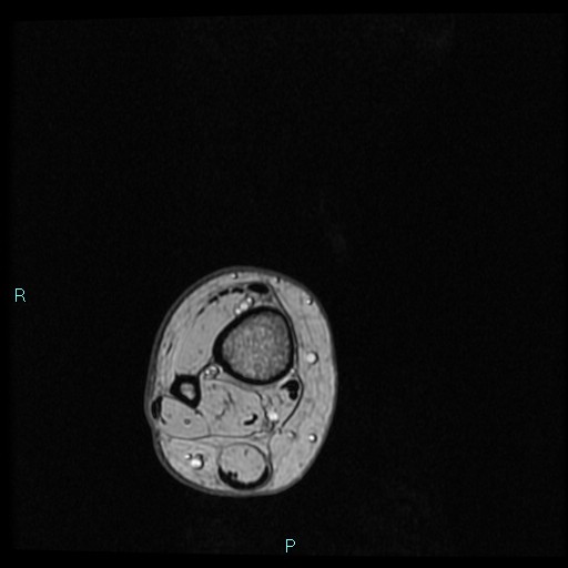 Ankle ganglion cyst (Radiopaedia 62809-71162 Axial Gradient Echo 103).jpg