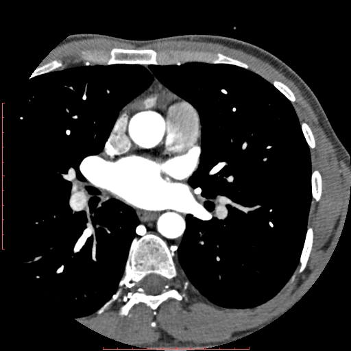 File:Anomalous left coronary artery from the pulmonary artery (ALCAPA) (Radiopaedia 70148-80181 A 59).jpg
