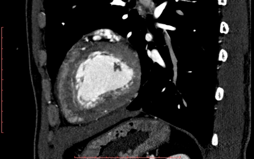 Anomalous left coronary artery from the pulmonary artery (ALCAPA) (Radiopaedia 70148-80181 C 190).jpg