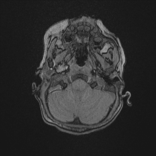 File:Anoxic brain injury (Radiopaedia 79165-92139 Axial MRA 33).jpg