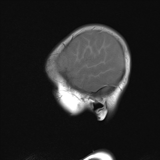 File:Anoxic brain injury (Radiopaedia 79165-92139 Sagittal T1 18).jpg