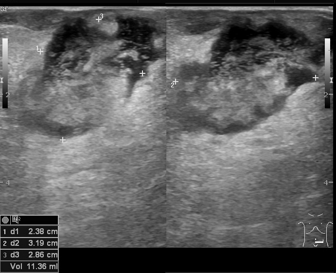 File:Anterior abdominal wall abscess (Radiopaedia 17732-17480 A 1).jpg