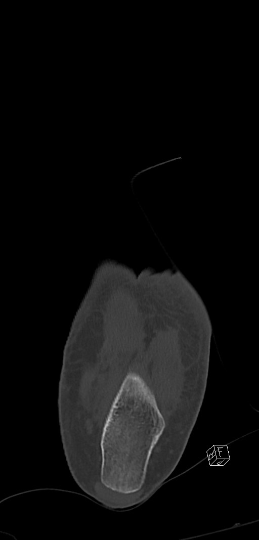 Anterior calcaneal process fracture (Radiopaedia 63353-71943 Coronal bone window 41).jpg