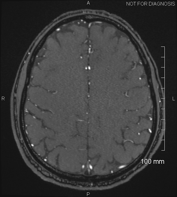 Anterior cerebral artery aneurysm (Radiopaedia 80683-94127 Axial MRA 181).jpg