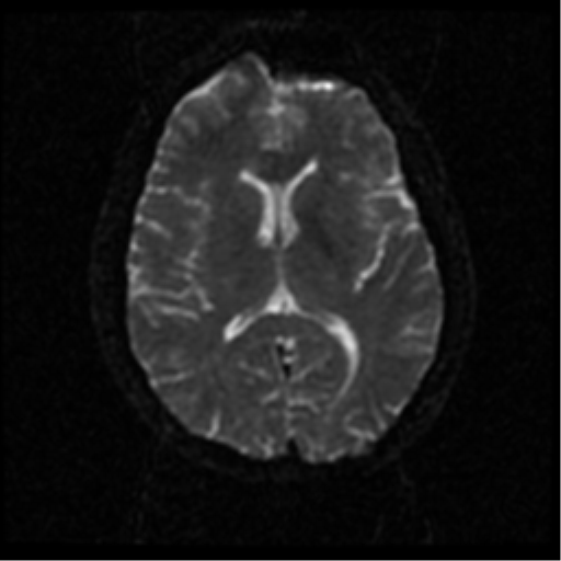 File:Anterior cerebral artery territory infarct (Radiopaedia 39327-41584 Axial DWI 39).png