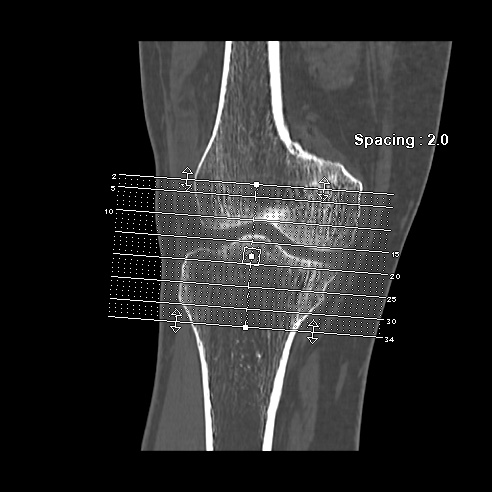 File:Anterior cruciate ligament avulsion fracture (Radiopaedia 58939-66194 Axial bone window 1).jpg
