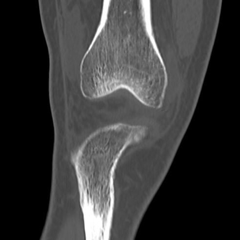 File:Anterior cruciate ligament avulsion fracture (Radiopaedia 58939-66194 Coronal bone window 4).jpg