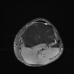 File:Anterior cruciate ligament full thickness tear (Radiopaedia 66268-75467 Axial PD fat sat 24).jpg