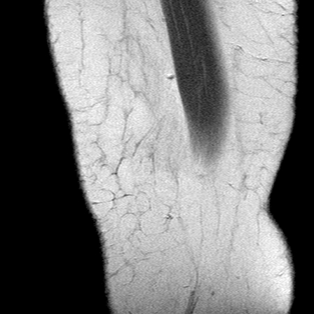 File:Anterior cruciate ligament mucoid degeneration (Radiopaedia 60853-68633 Sagittal PD 4).jpg
