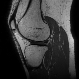 Anterior cruciate ligament rupture and posteromedial corner injury (Radiopaedia 67338-76723 Sagittal PD 117).jpg