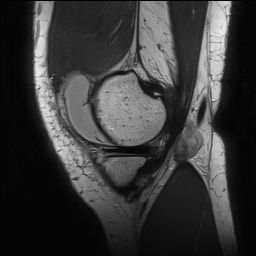 Anterior cruciate ligament rupture with Segond fracture (Radiopaedia 69043-78806 Sagittal PD 41).jpg